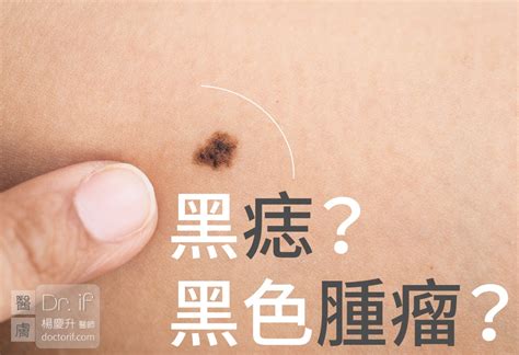 脖子長黑斑|皮膚長痣、長斑是皮膚癌前兆？皮膚癌初期4大症狀快。